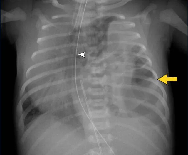 Neonatal CXR: Pneumothorax with chest tube