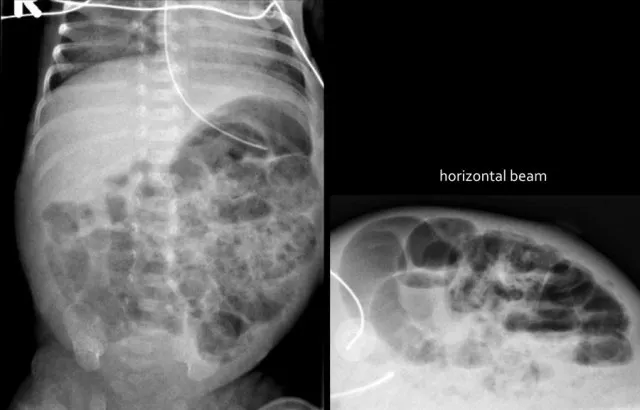 Neonatal Abdominal X-ray: Pneumatosis Intestinalis