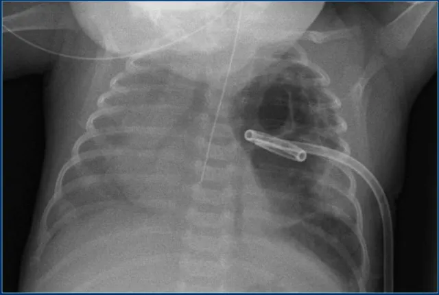 Neonatal Chest X-ray: Multiple Lines and Tubes
