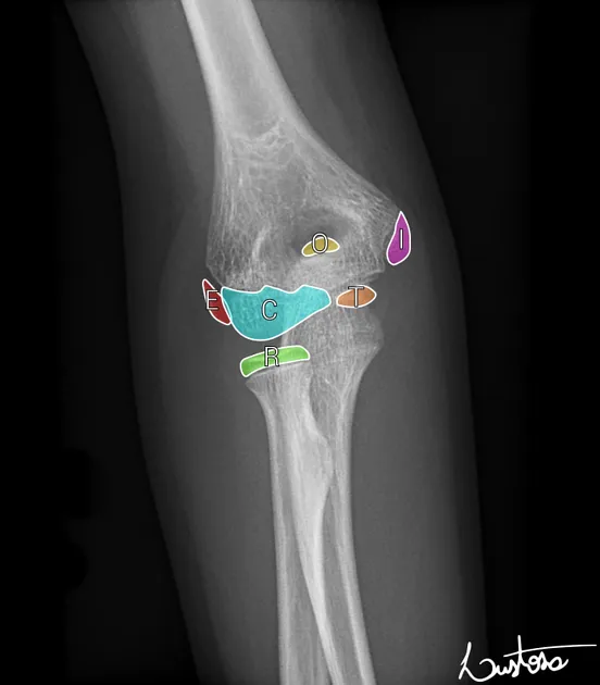 Pediatric elbow ossification centers (CRITOE)