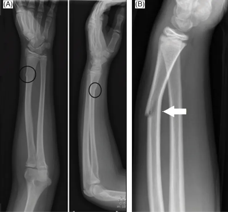 Pediatric forearm fractures: torus and greenstick