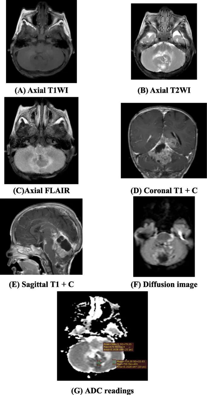 Pediatric posterior fossa tumor MRI series