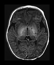 Neonatal HIE basal ganglia and thalami injury on MRI