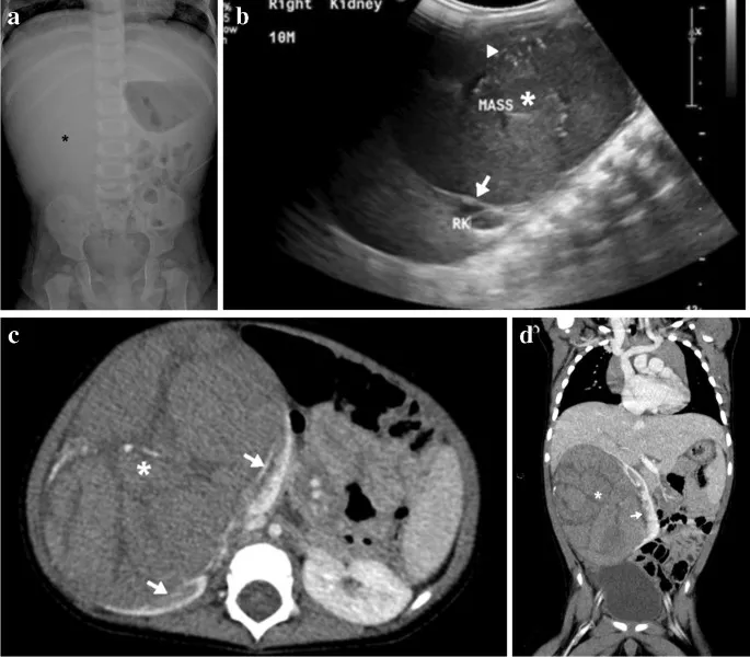 Wilms tumor imaging: X-ray, ultrasound, and CT
