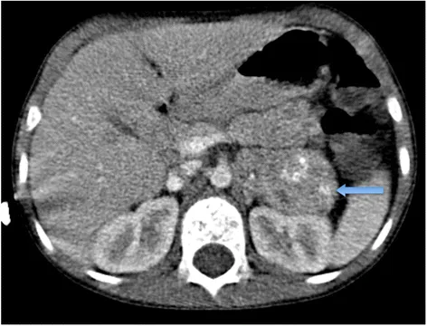 CT scan of adrenal neuroblastoma with calcification