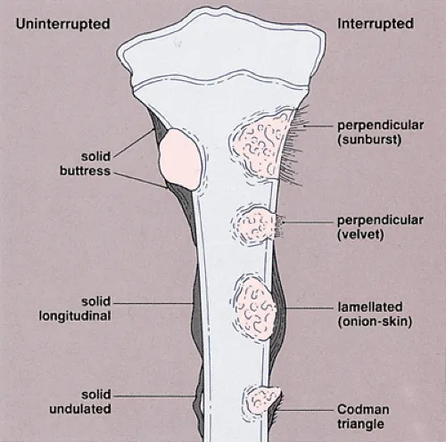 Periosteal reactions: sunburst, onion-skin, Codman triangle