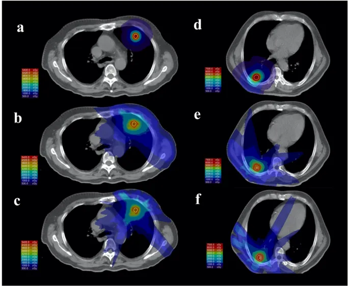 Dose distributions: 3D-CRT, IMRT, Proton Therapy