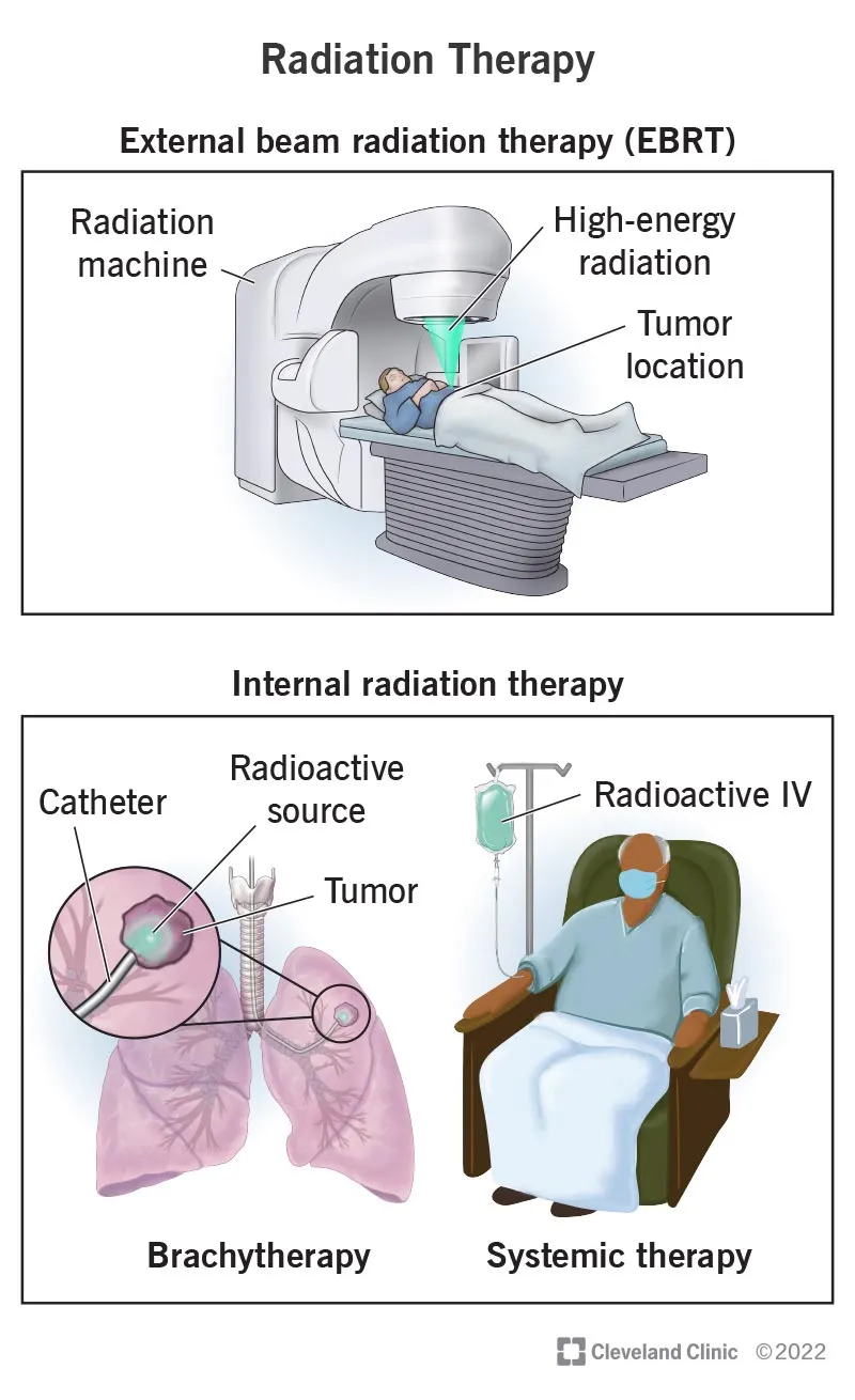 External Beam Radiation Therapy (EBRT) Diagram