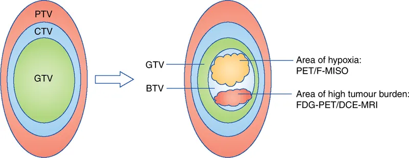GTV, CTV, PTV, and BTV in Radiation Therapy