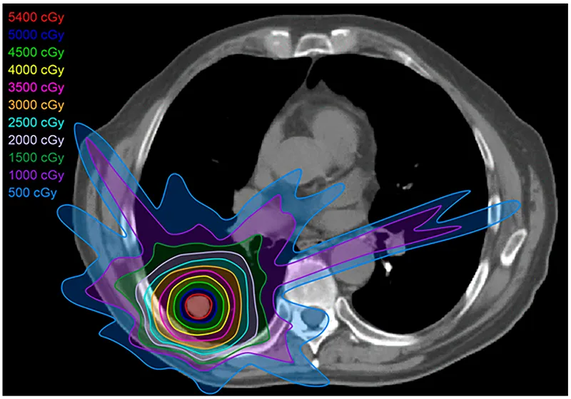IMRT dose distribution in chest