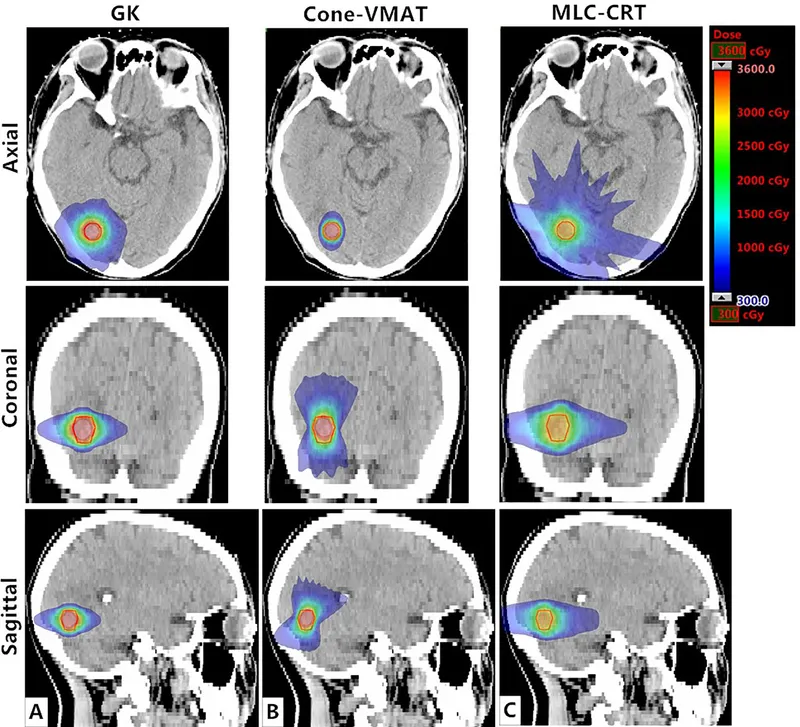SRS Dose Distribution Comparison