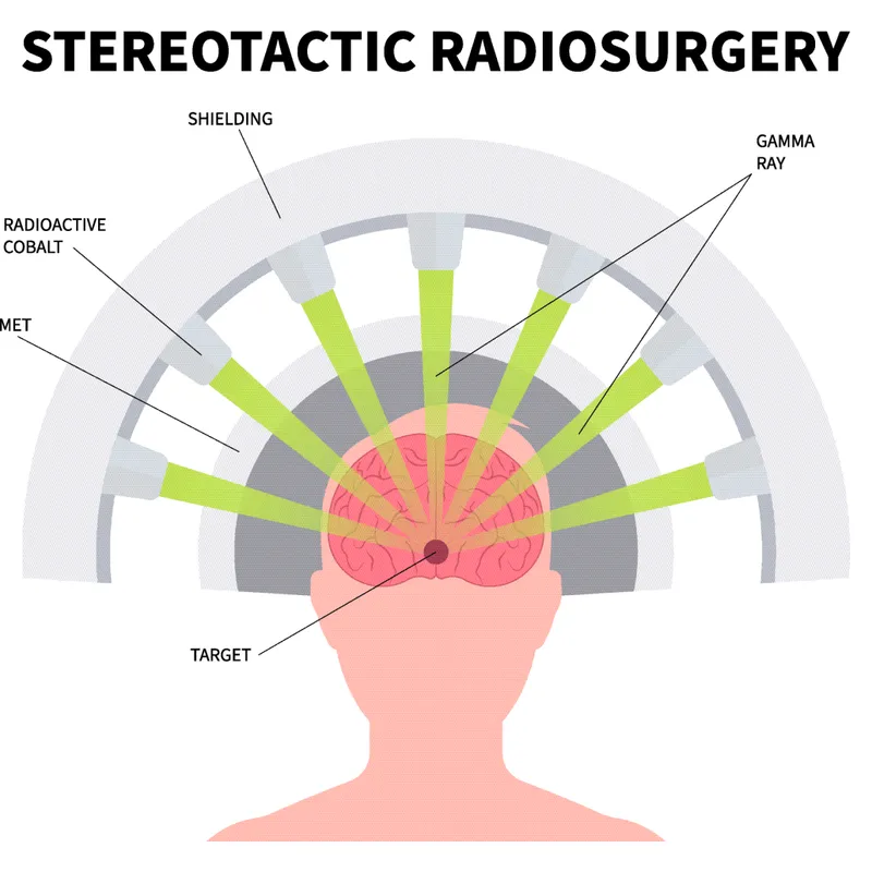 Stereotactic Radiosurgery Targeting