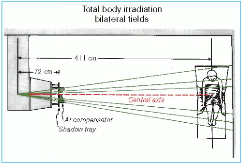 Total Body Irradiation: Bilateral Fields Setup