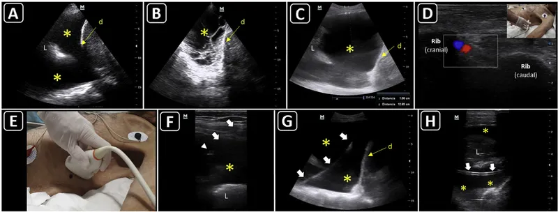 Ultrasound guided thoracentesis landmarks and needle path