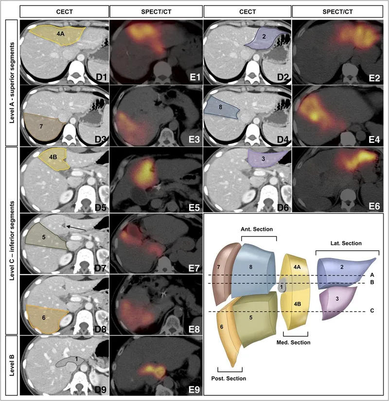 Axial CT and SPECT/CT of liver segments