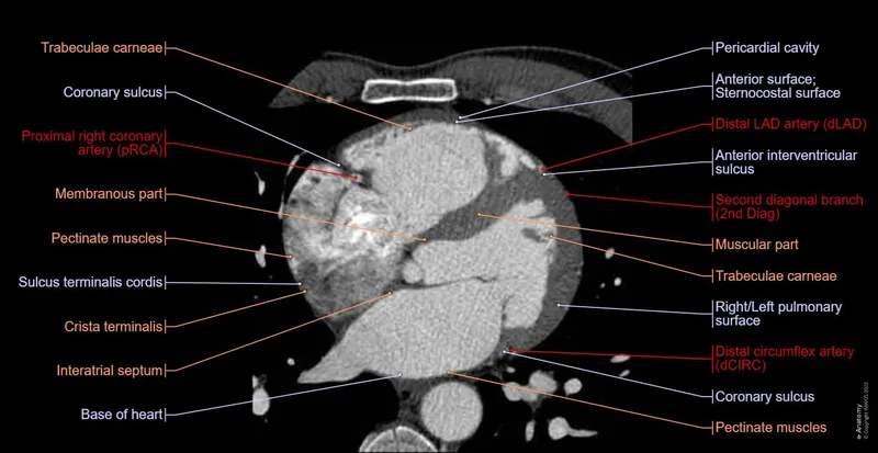 Axial CT cardiac view with labels