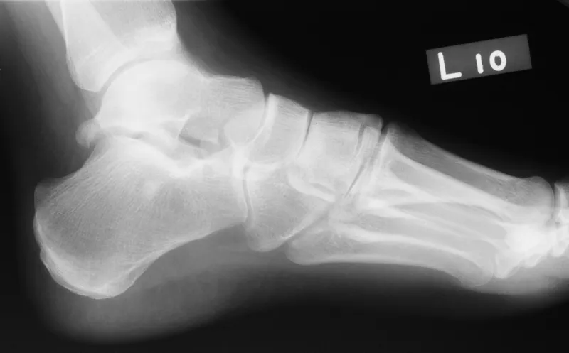 Os trigonum on lateral ankle X-ray