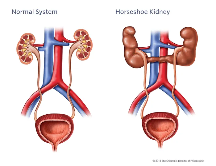 Normal vs Horseshoe Kidney Anatomy