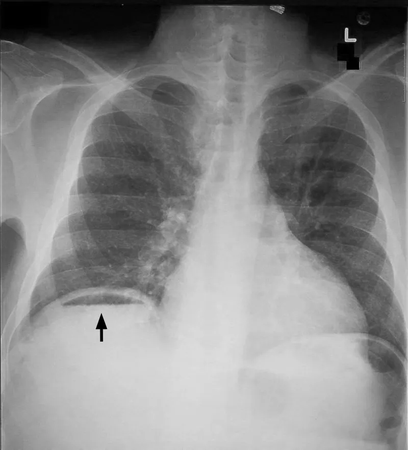 Erect chest X-ray: Free air under diaphragm