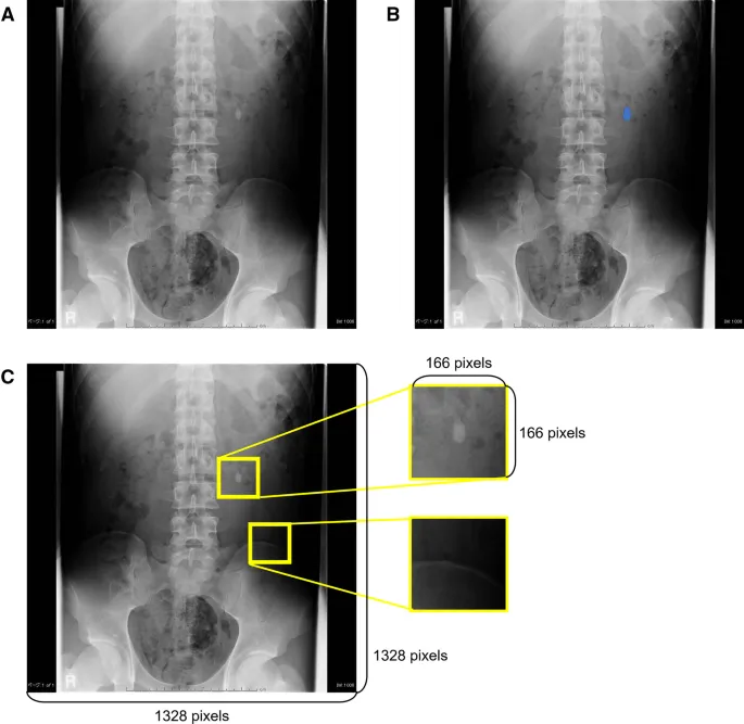 KUB X-ray: Renal calculi and phleboliths