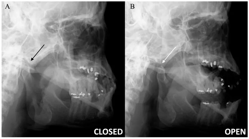 TMJ Radiograph: Closed vs. Open Mouth Views