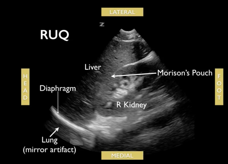 RUQ Ultrasound: Morrison's Pouch