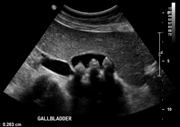 Gallbladder ultrasound with gallstones and shadowing