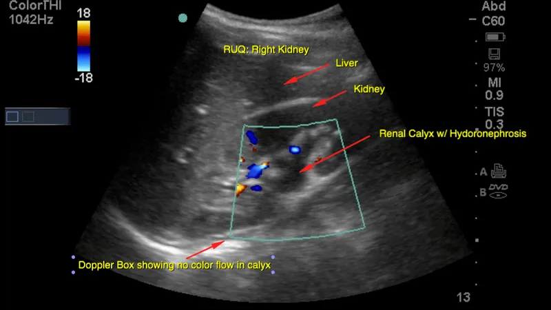 Ultrasound of hydronephrosis with Doppler box
