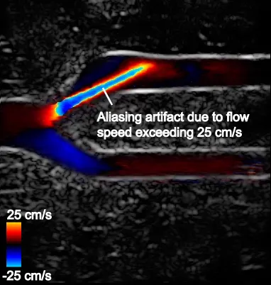 Doppler ultrasound aliasing artifact