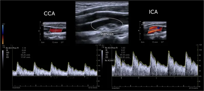 Carotid Artery Stenosis: Color and Spectral Doppler