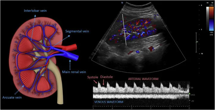 Renal Doppler Ultrasound with Arterial and Venous Waveforms