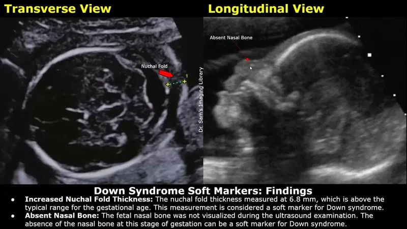 Down Syndrome Soft Markers: Nuchal Fold, Absent Nasal Bone