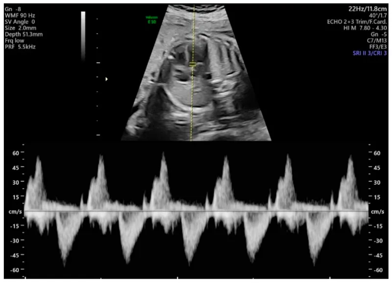 Fetal Doppler ultrasound waveform