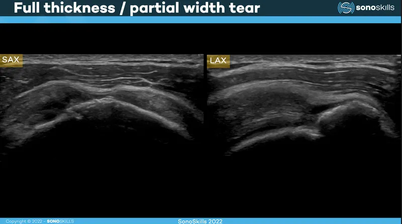 Rotator cuff tear ultrasound (SAX and LAX)