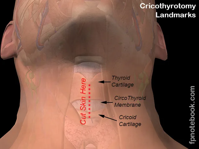 Cricothyroidotomy Landmarks and Incision Site