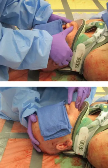 Jaw thrust maneuver with cervical collar