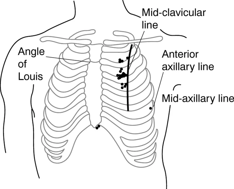 Needle Thoracostomy Landmarks