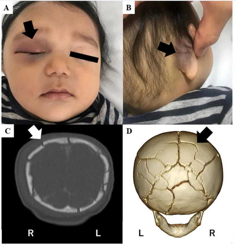 Basilar Skull Fracture: Raccoon Eyes, Battle's Sign, CT