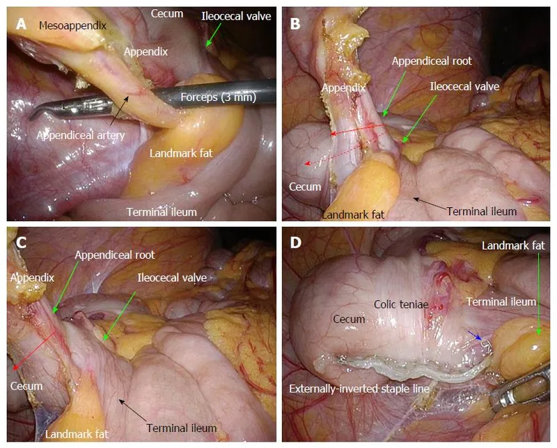 Laparoscopic appendectomy steps with anatomical landmarks