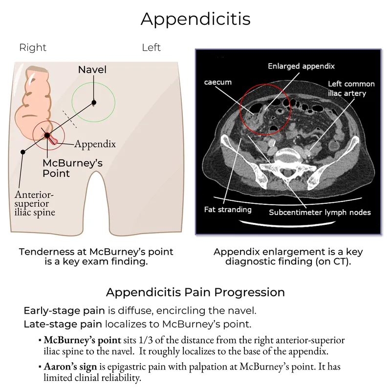 Appendicitis: Anatomy, McBurney's Point, and CT Findings
