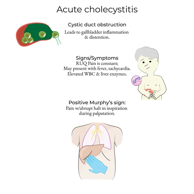 Acute Cholecystitis: Symptoms and Murphy's Sign