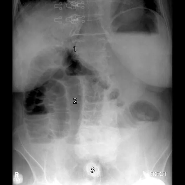Abdominal X-ray: Rigler's triad in gallstone ileus