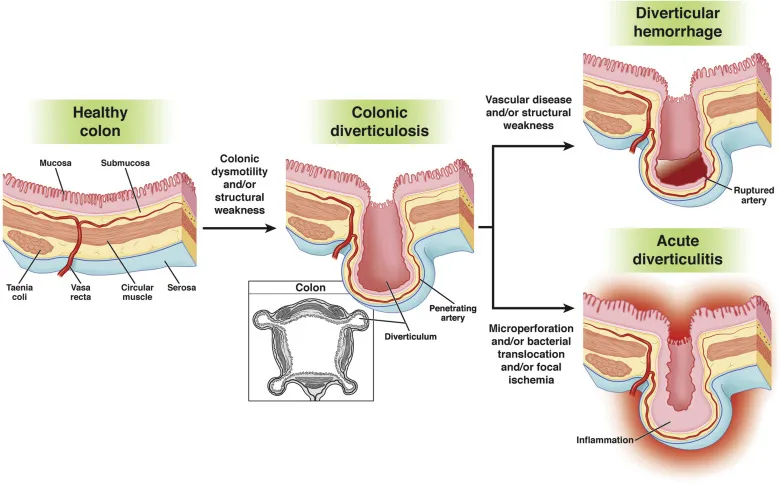 Diverticulosis, hemorrhage, and acute diverticulitis