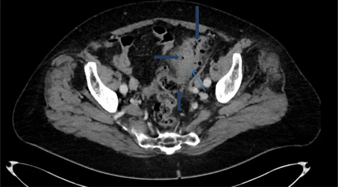CT scan of acute diverticulitis with pericolic abscess