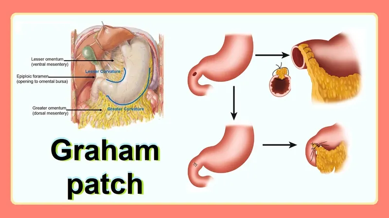 Graham patch repair for perforated peptic ulcer