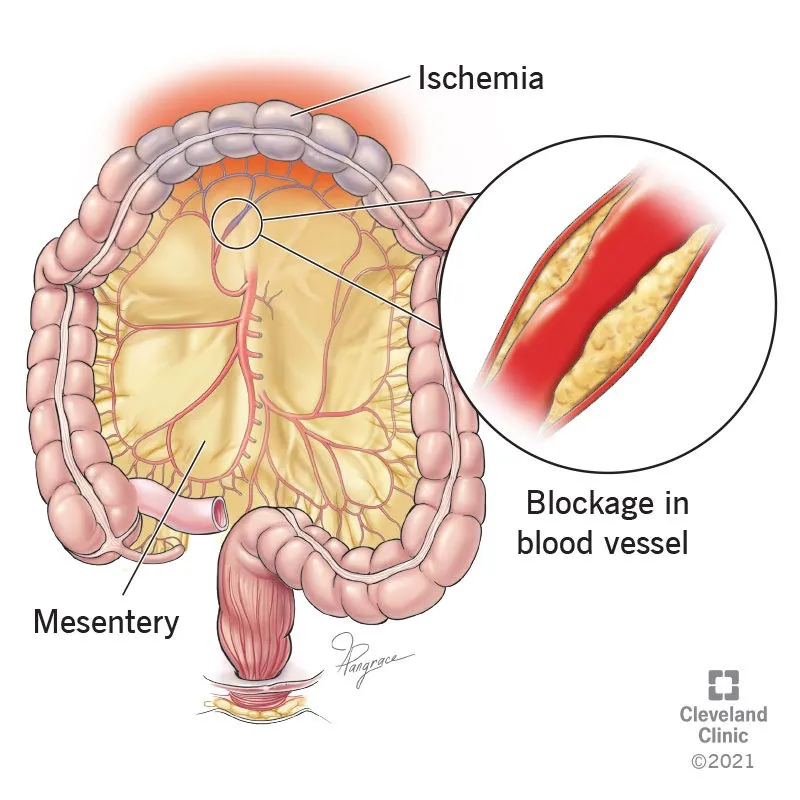 Mesenteric Ischemia: Intestine, Mesentery, Blockage