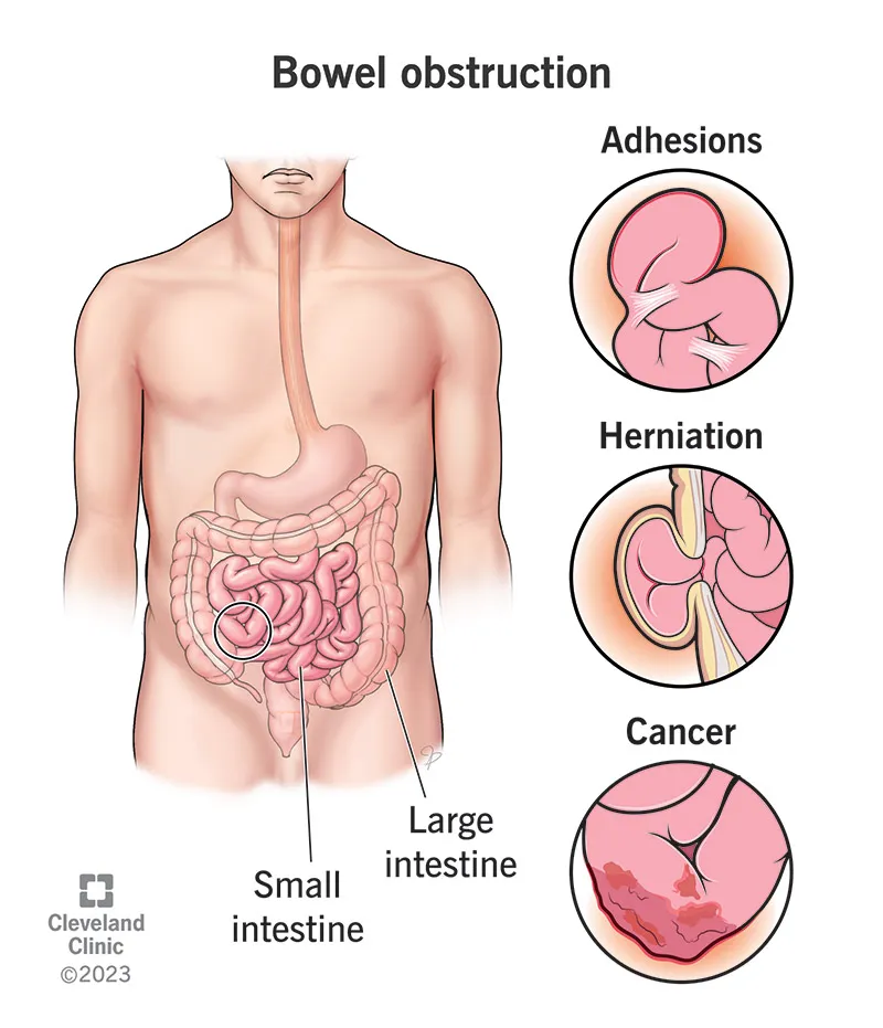 Small Bowel Obstruction: Causes