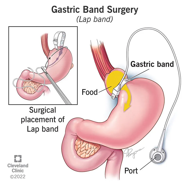 Gastric Band Surgery (Lap band)