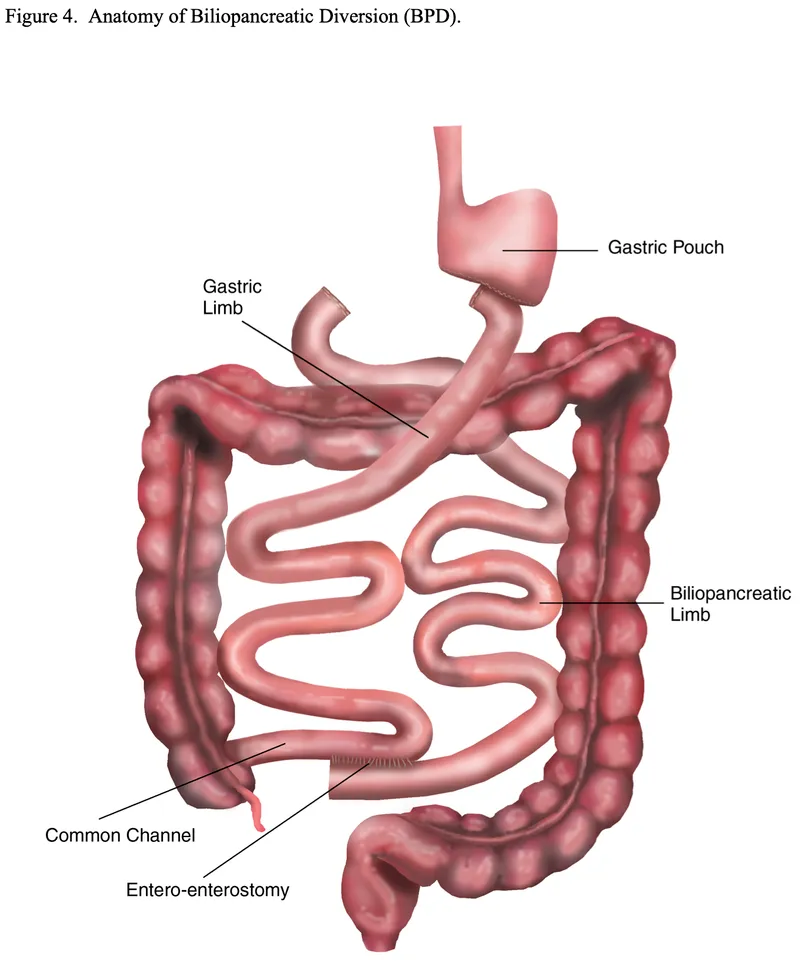 Anatomy of Biliopancreatic Diversion (BPD)