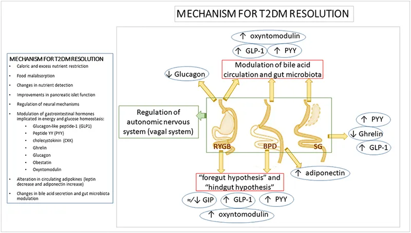 Mechanisms of T2DM Resolution After Bariatric Surgery